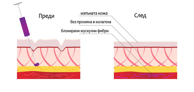 ботокс цена варна