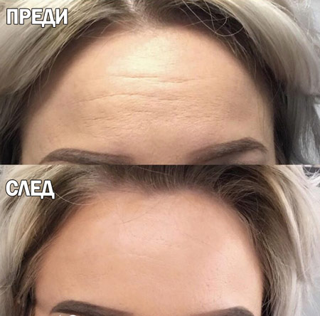 ботокс цена варна