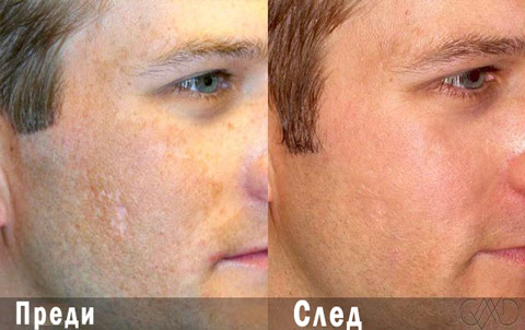 ob_9e2594_microneedling-with-prp-therapy Плазмолифтинг варна