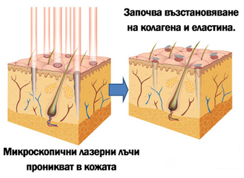 Лазерен пилинг варна