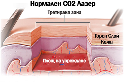 Лазерен пилинг варна