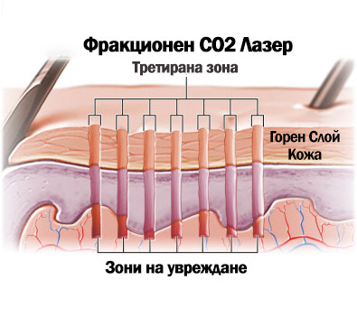 лазерен пилинг