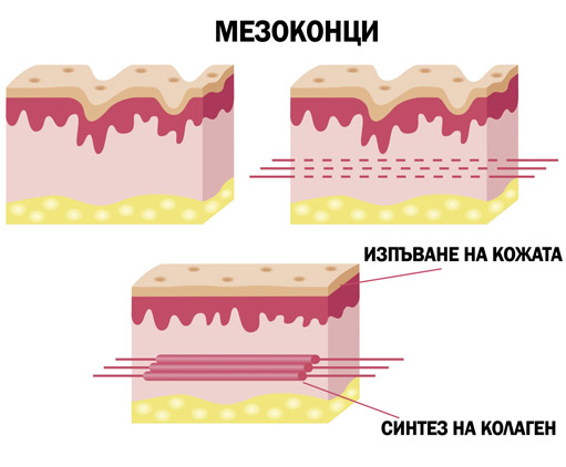 Поставяне на мезоконци